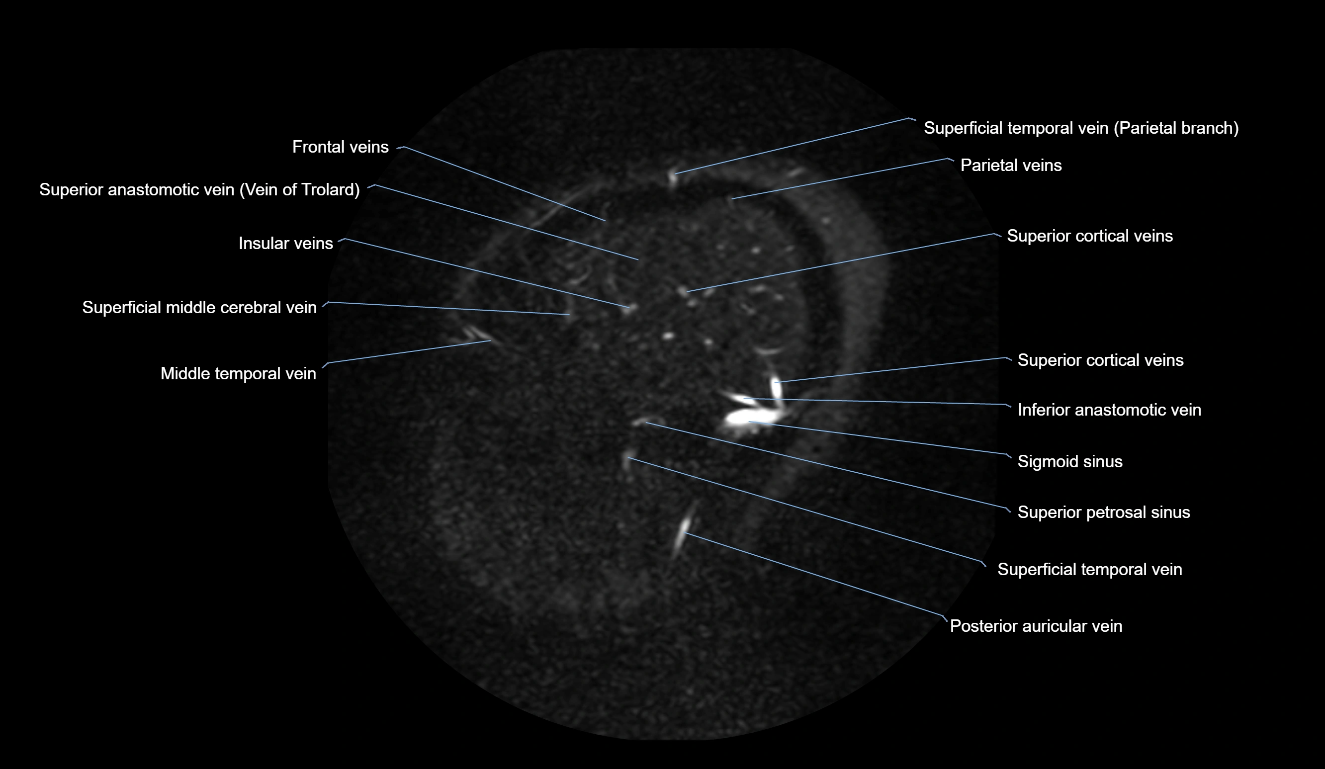MRV brain sagittal anatomy 3T MRI labelledimages -00015.webp